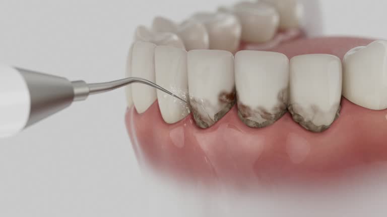 Reliable Dental Implants contractor in Katy, TX by Smile Center Dentistry